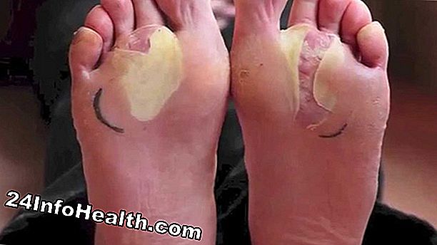 Síntomas, causas y preguntas comunes de los moretones en los dedos de los pies