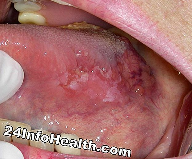 Síntomas, causas y opciones de tratamiento de la boca inflamada