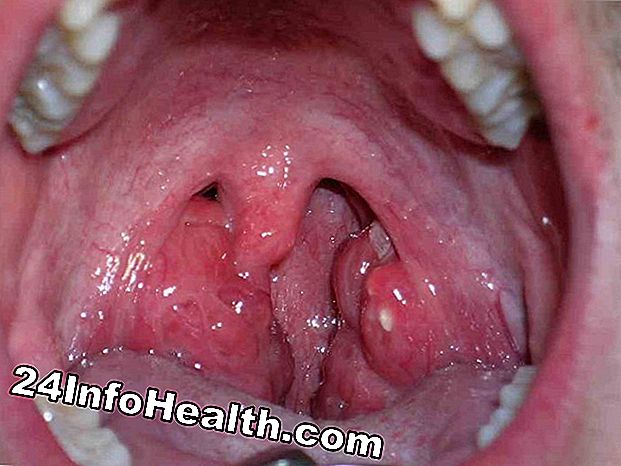 Dolor bucal que se asemeja al herpes oral Síntoma, causas y preguntas