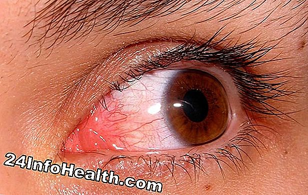 Enfermedades y condiciones: Dolor alrededor de los ojos Síntomas, causas y preguntas comunes