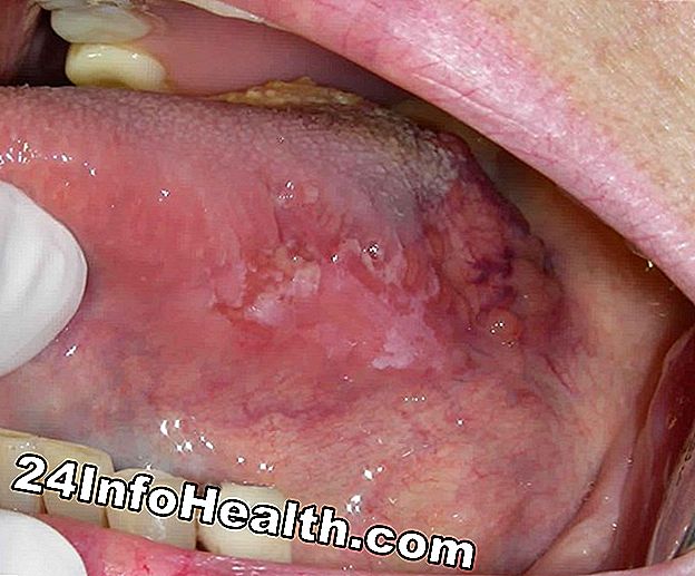 Enfermedades y condiciones: Dolor en la parte baja de los síntomas premolares, causas y preguntas