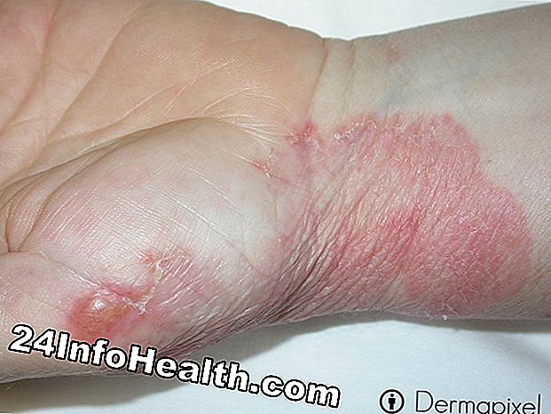 Enfermedades y condiciones: Síntomas de enrojecimiento del dedo del pie, causas y preguntas comunes
