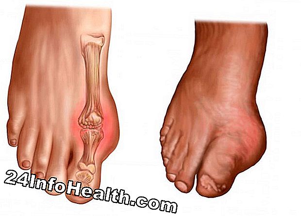 Malattie e condizioni: Limping sul lato esterno del piede Sintomo, cause e domande