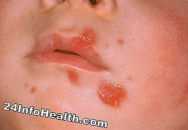 Malattie e condizioni: Pale Skin Around the Lips Sintomi, cause e statistiche