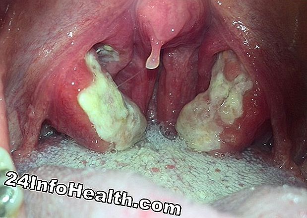 Malattie e condizioni: Solletico in gola sintomi, cause e opzioni di trattamento