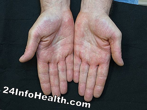 Malattie e condizioni: Pelle ispessita sul palmo della mano Sintomi e cause