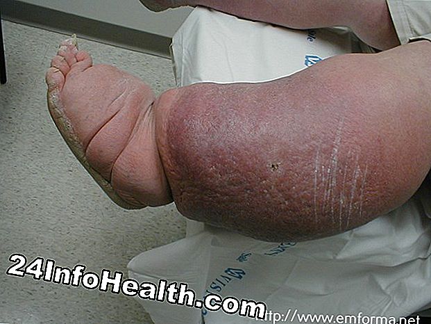 Doenças e condições: Knee coceira sintomas, causas e perguntas comuns