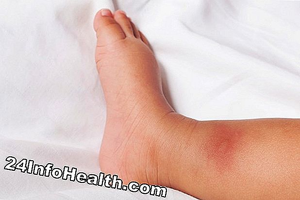 Doenças e condições: Parte traseira dos sintomas de inchaço da mão, causas e perguntas comuns