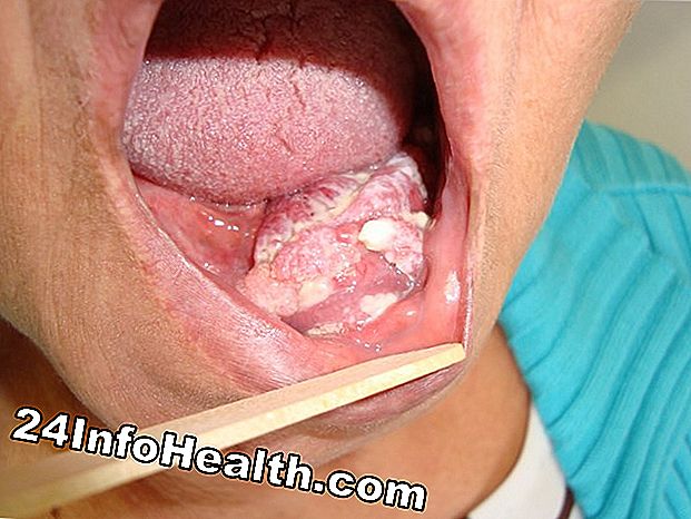 Doenças e condições: Sintomas da boca inchada, causas e opções de tratamento