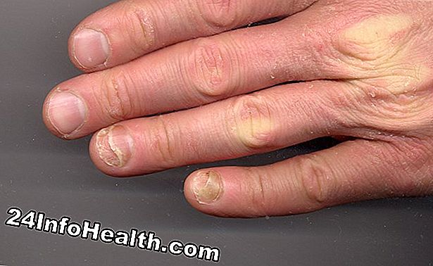 Sjukdomar och villkor: Hand Skin Changes Symptom, orsaker och vanliga frågor