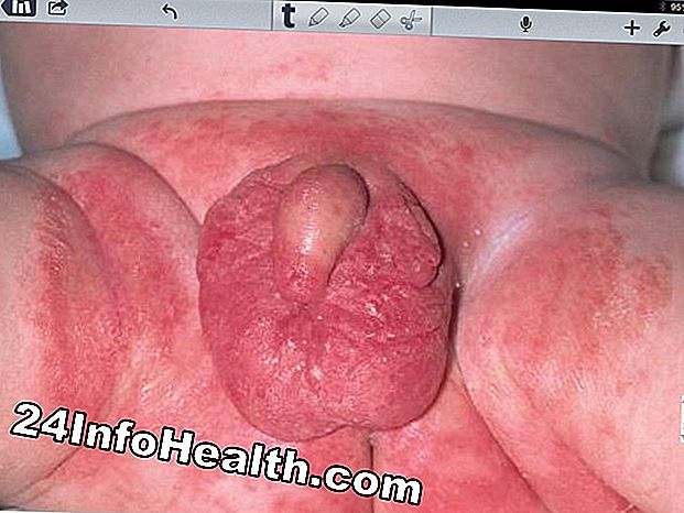 Sjukdomar och villkor: Vulvovaginal Redness Symptom, orsaker och vanliga frågor