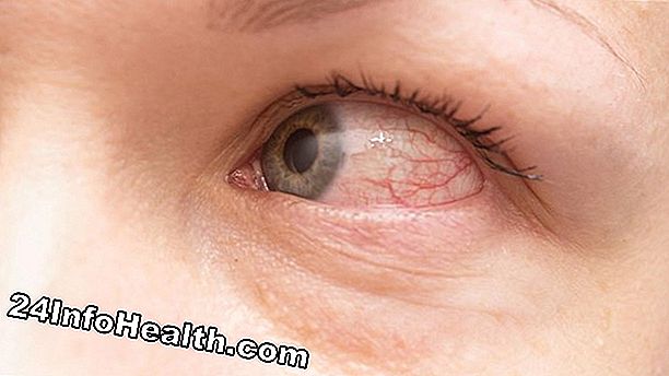 Bệnh & điều kiện: Morning Eye Crust Các triệu chứng, nguyên nhân và câu hỏi thường gặp